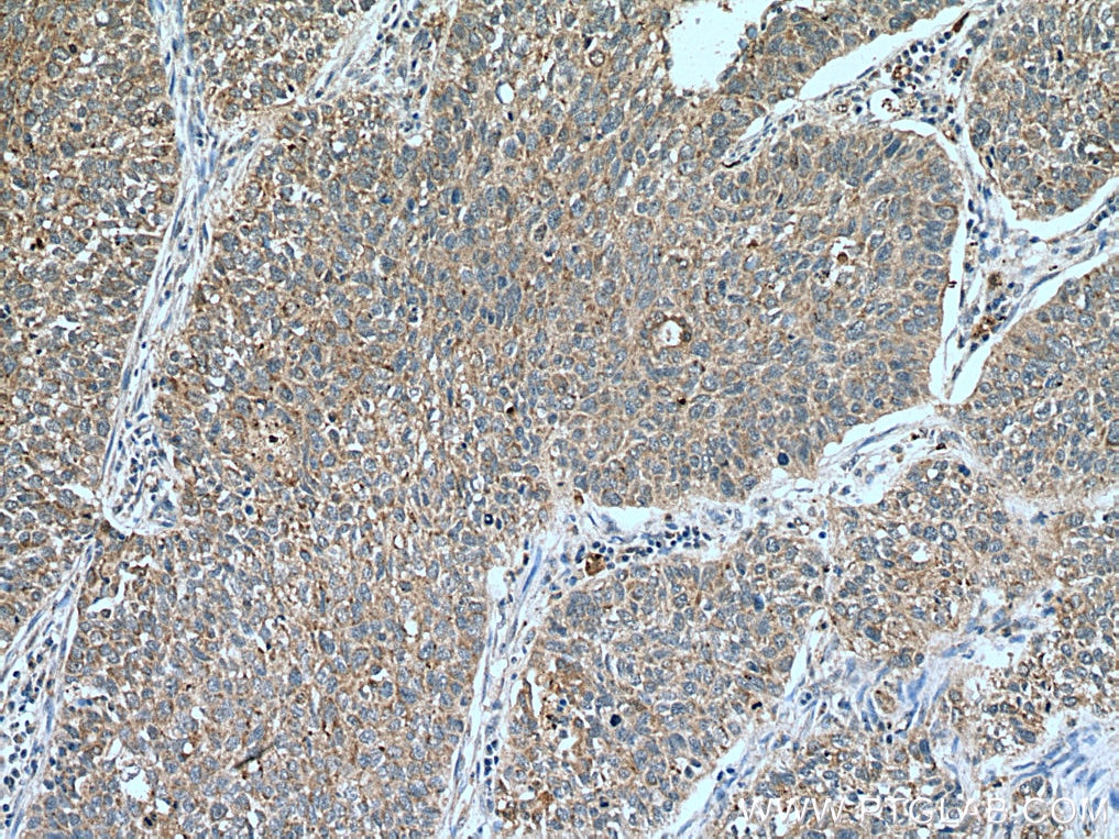 Immunohistochemistry (IHC) staining of human lung cancer tissue using BCAT1 Polyclonal antibody (28622-1-AP)