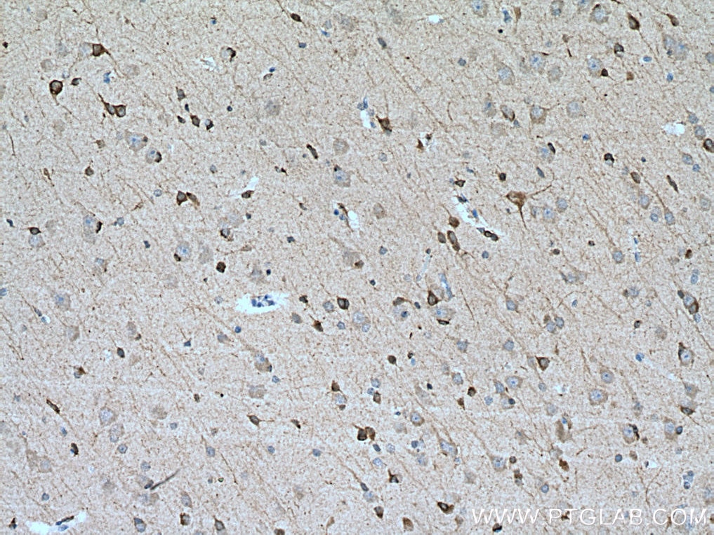 Immunohistochemistry (IHC) staining of human gliomas tissue using BCAT1 Polyclonal antibody (28622-1-AP)