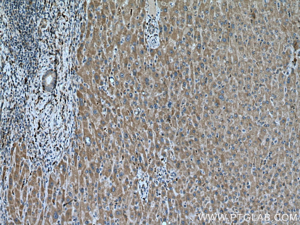 Immunohistochemistry (IHC) staining of human liver cancer tissue using BCAT1 Polyclonal antibody (28622-1-AP)