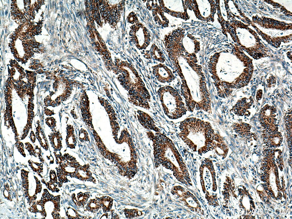 Immunohistochemistry (IHC) staining of human colon cancer tissue using BCKDHB Polyclonal antibody (13685-1-AP)