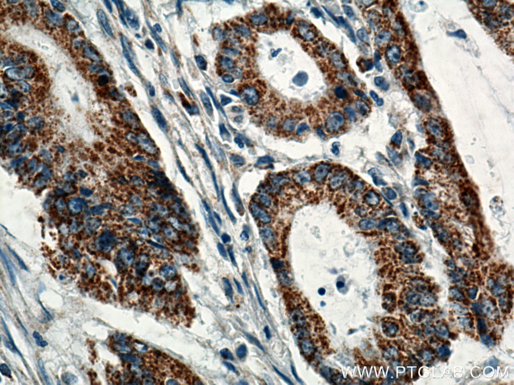 Immunohistochemistry (IHC) staining of human colon cancer tissue using BCKDHB Polyclonal antibody (13685-1-AP)