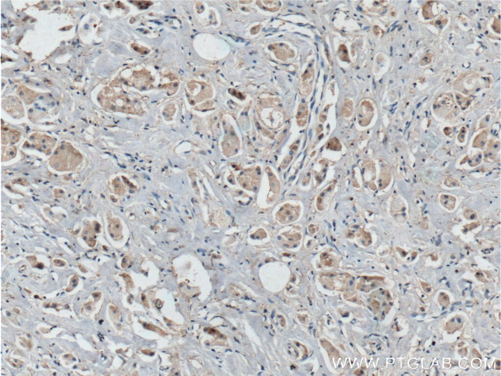 Immunohistochemistry (IHC) staining of human breast cancer tissue using BCL10 Polyclonal antibody (17732-1-AP)