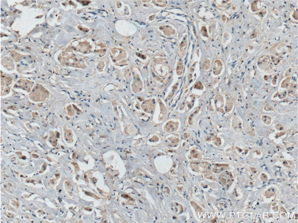 Immunohistochemistry (IHC) staining of human breast cancer tissue using BCL10 Polyclonal antibody (17732-1-AP)