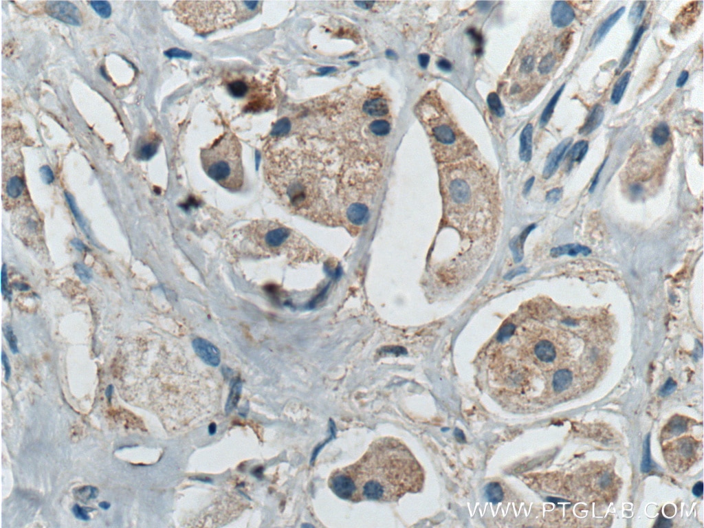 Immunohistochemistry (IHC) staining of human breast cancer tissue using BCL10 Polyclonal antibody (17732-1-AP)