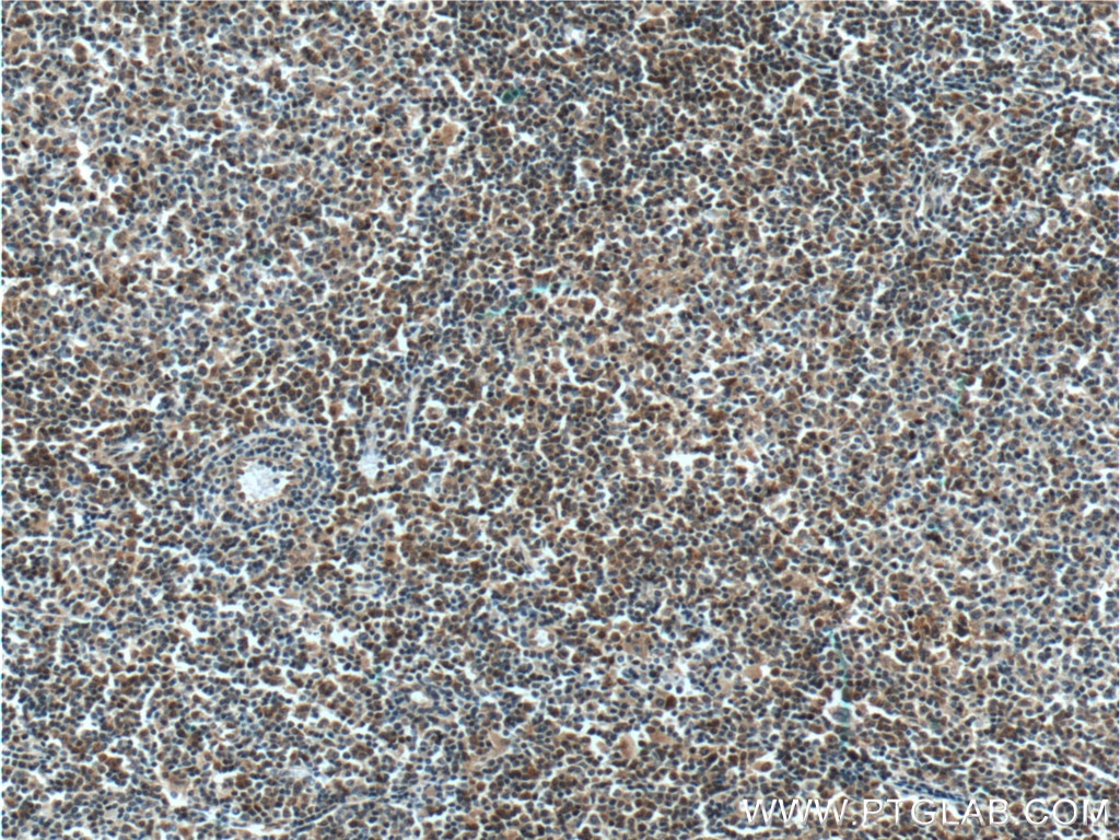 Immunohistochemistry (IHC) staining of human lymphoma tissue using BCL10 Polyclonal antibody (17732-1-AP)