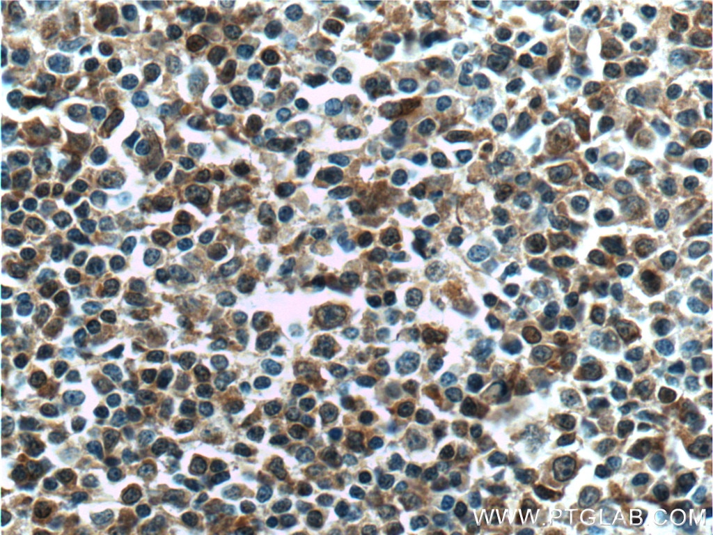 Immunohistochemistry (IHC) staining of human lymphoma tissue using BCL10 Polyclonal antibody (17732-1-AP)