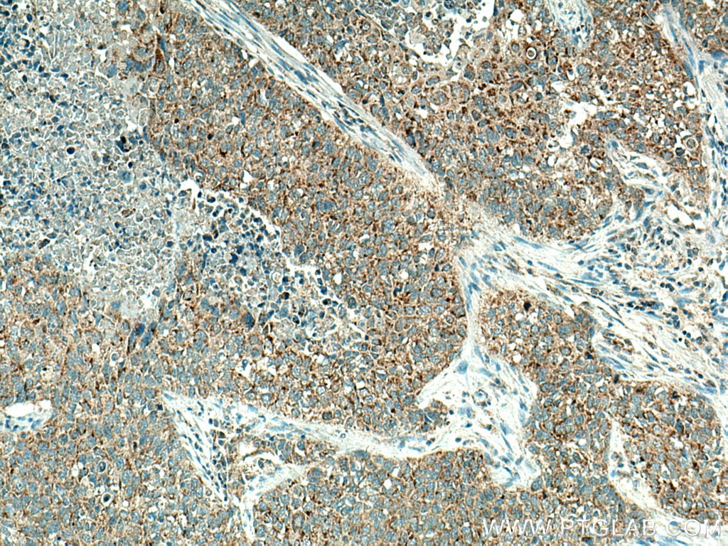 Immunohistochemistry (IHC) staining of human lung cancer tissue using BCL10 Polyclonal antibody (50180-1-AP)