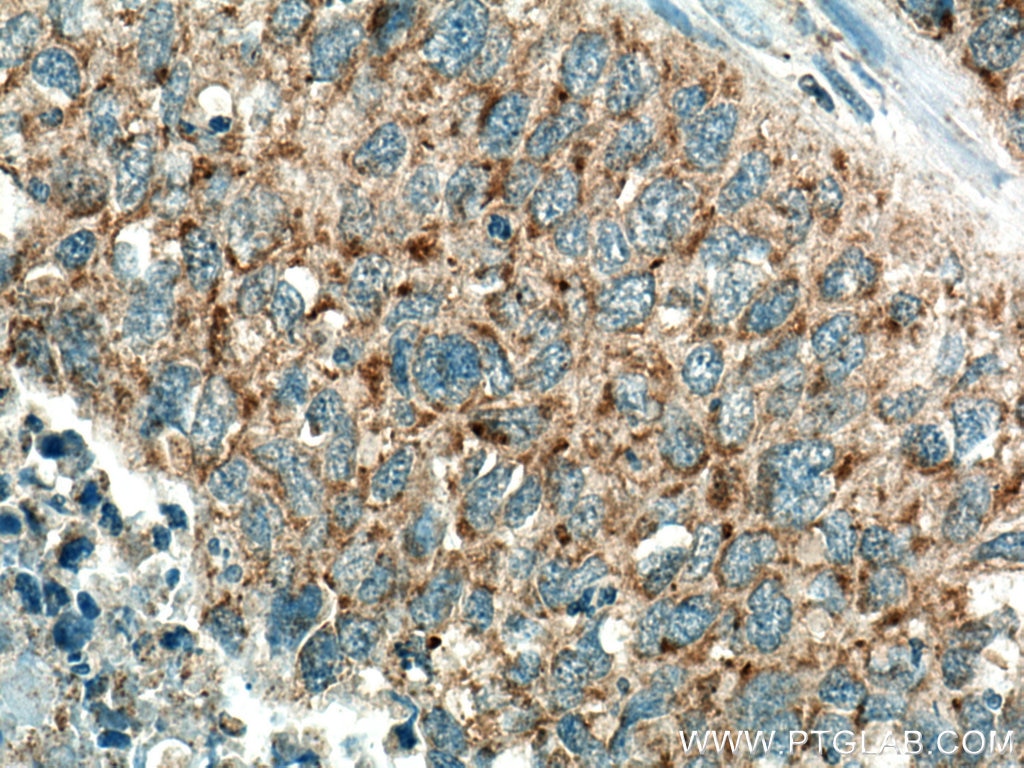 Immunohistochemistry (IHC) staining of human lung cancer tissue using BCL10 Polyclonal antibody (50180-1-AP)