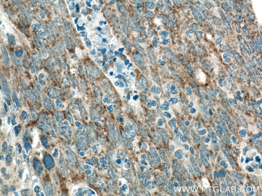 Immunohistochemistry (IHC) staining of human colon cancer tissue using BCL10 Polyclonal antibody (50180-1-AP)