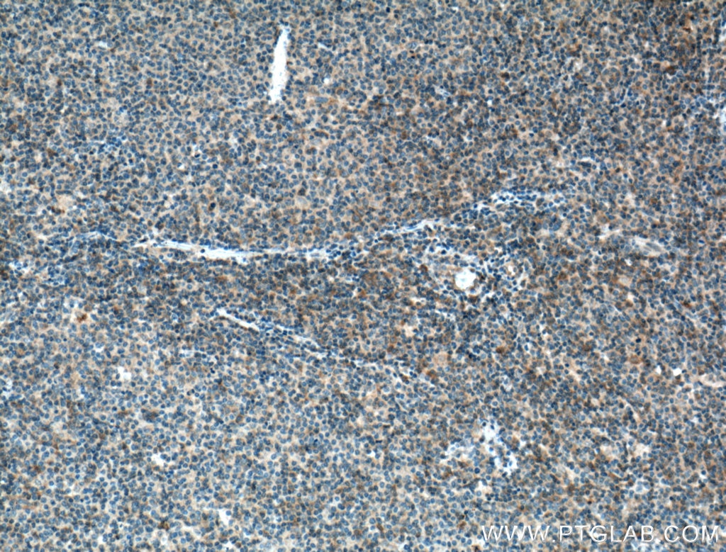 Immunohistochemistry (IHC) staining of human lymphoma tissue using BCL10 Monoclonal antibody (66556-1-Ig)
