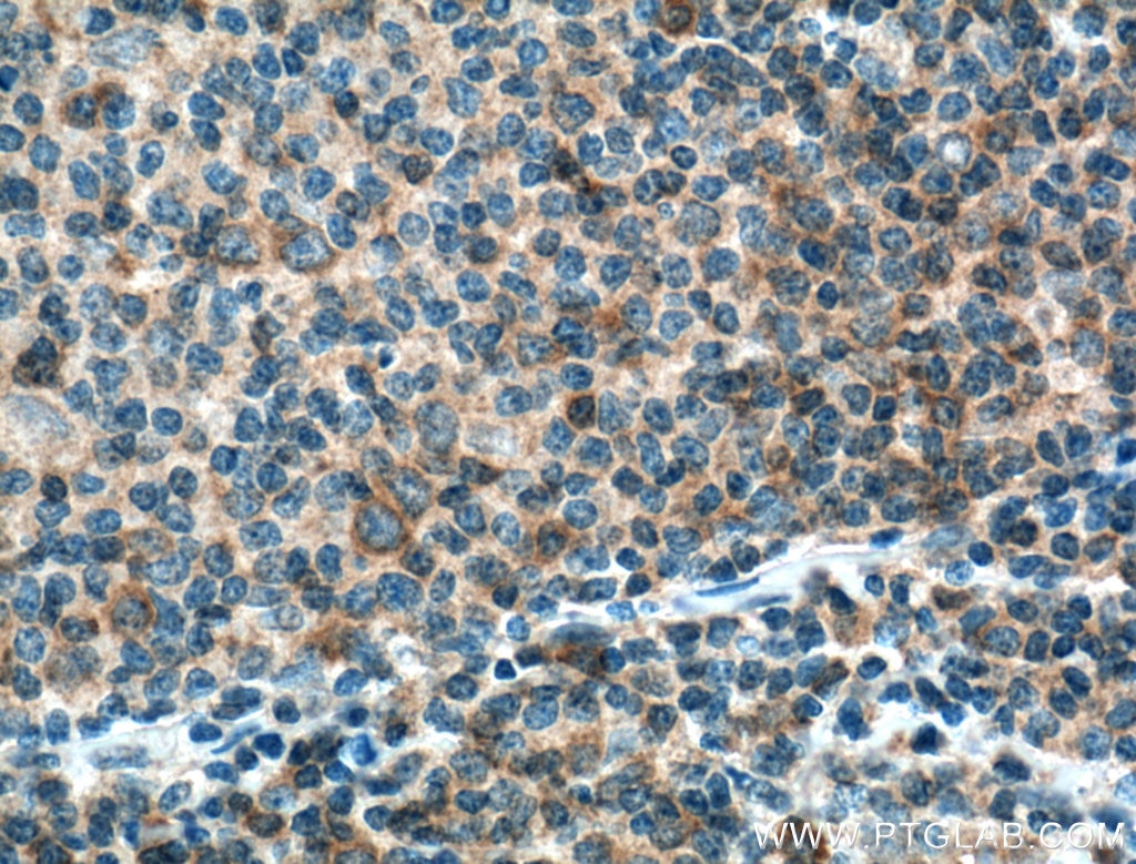 Immunohistochemistry (IHC) staining of human lymphoma tissue using BCL10 Monoclonal antibody (66556-1-Ig)