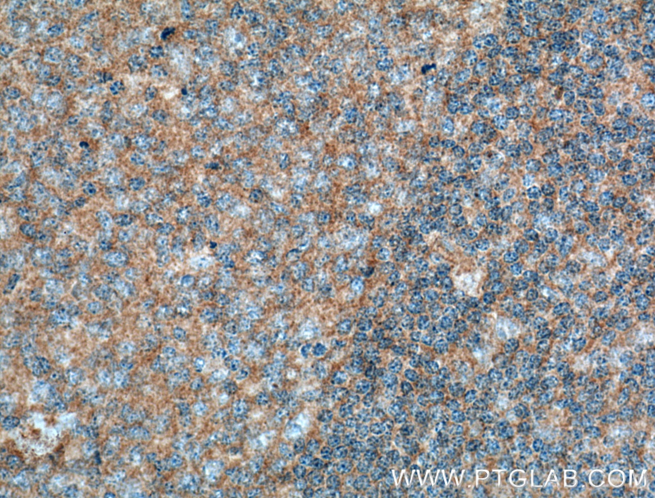 Immunohistochemistry (IHC) staining of human tonsillitis tissue using BCL10 Monoclonal antibody (66556-1-Ig)