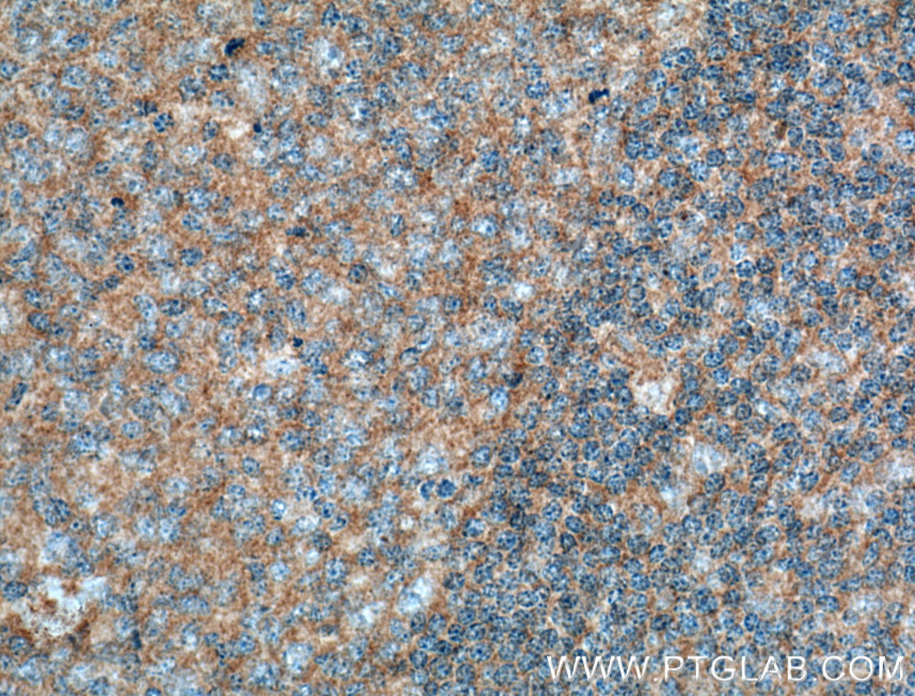 Immunohistochemistry (IHC) staining of human tonsillitis tissue using BCL10 Monoclonal antibody (66556-1-Ig)