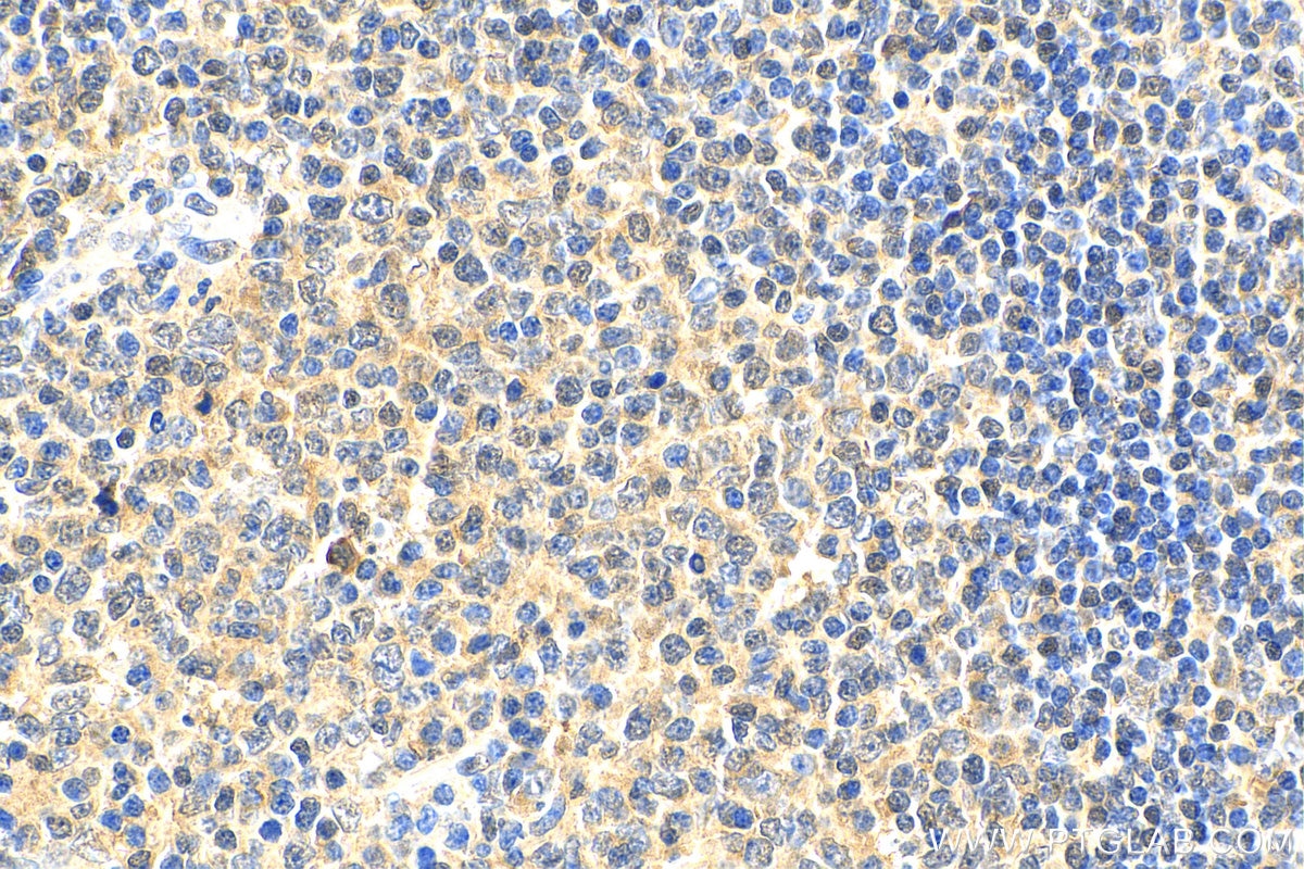 Immunohistochemistry (IHC) staining of human tonsillitis tissue using BCL11A Polyclonal antibody (11613-1-AP)
