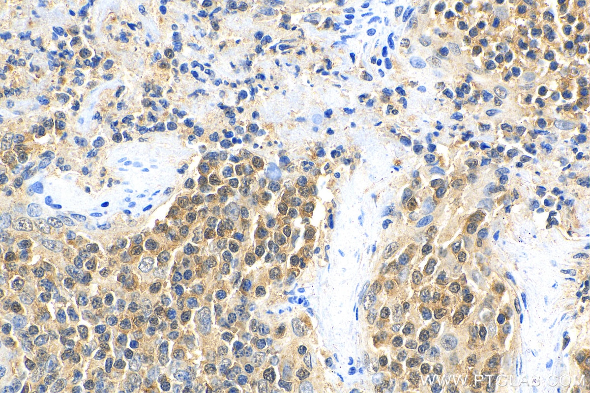 Immunohistochemistry (IHC) staining of human tonsillitis tissue using BCL11A Polyclonal antibody (11613-1-AP)