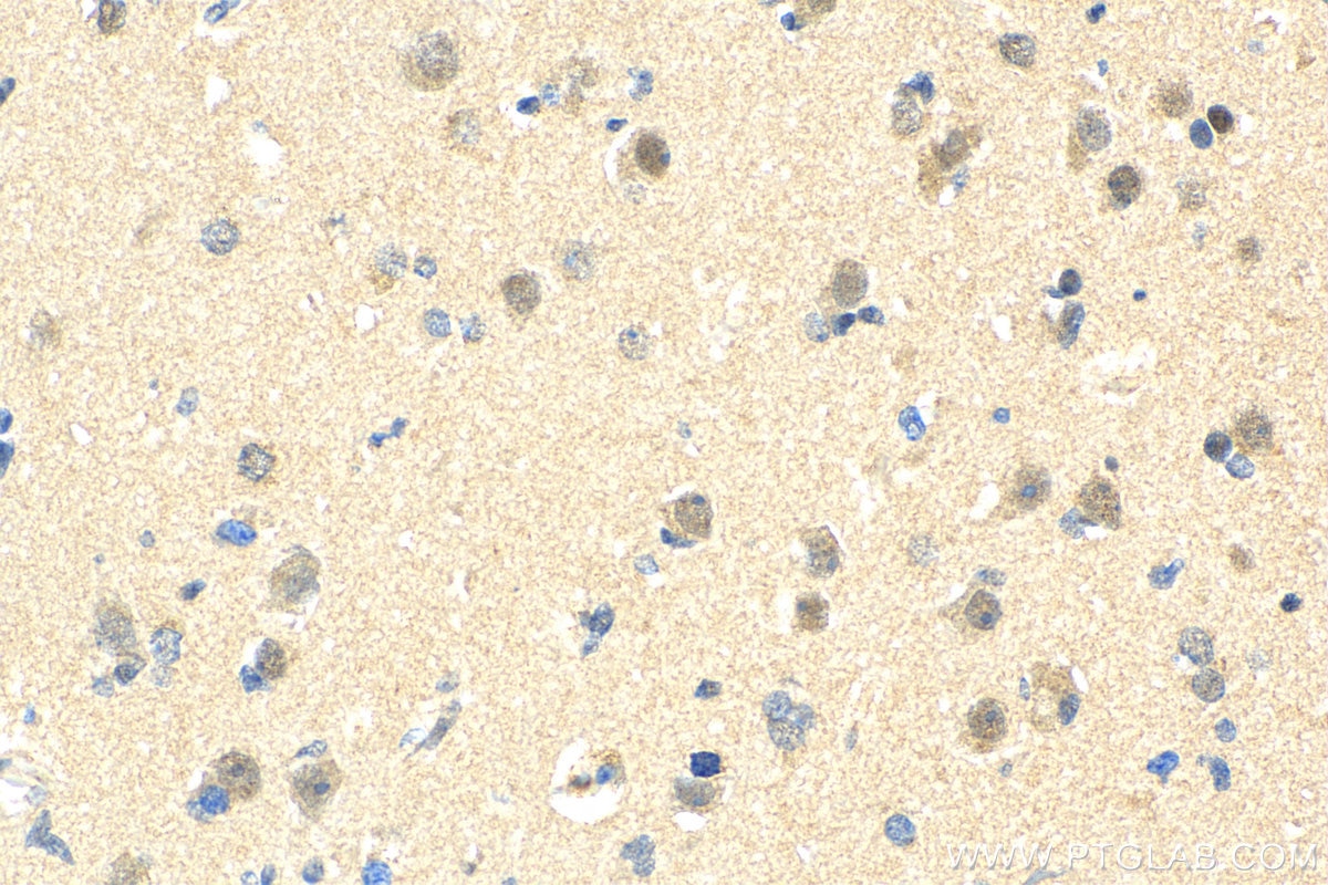 Immunohistochemistry (IHC) staining of human gliomas tissue using BCL11A Polyclonal antibody (11613-1-AP)