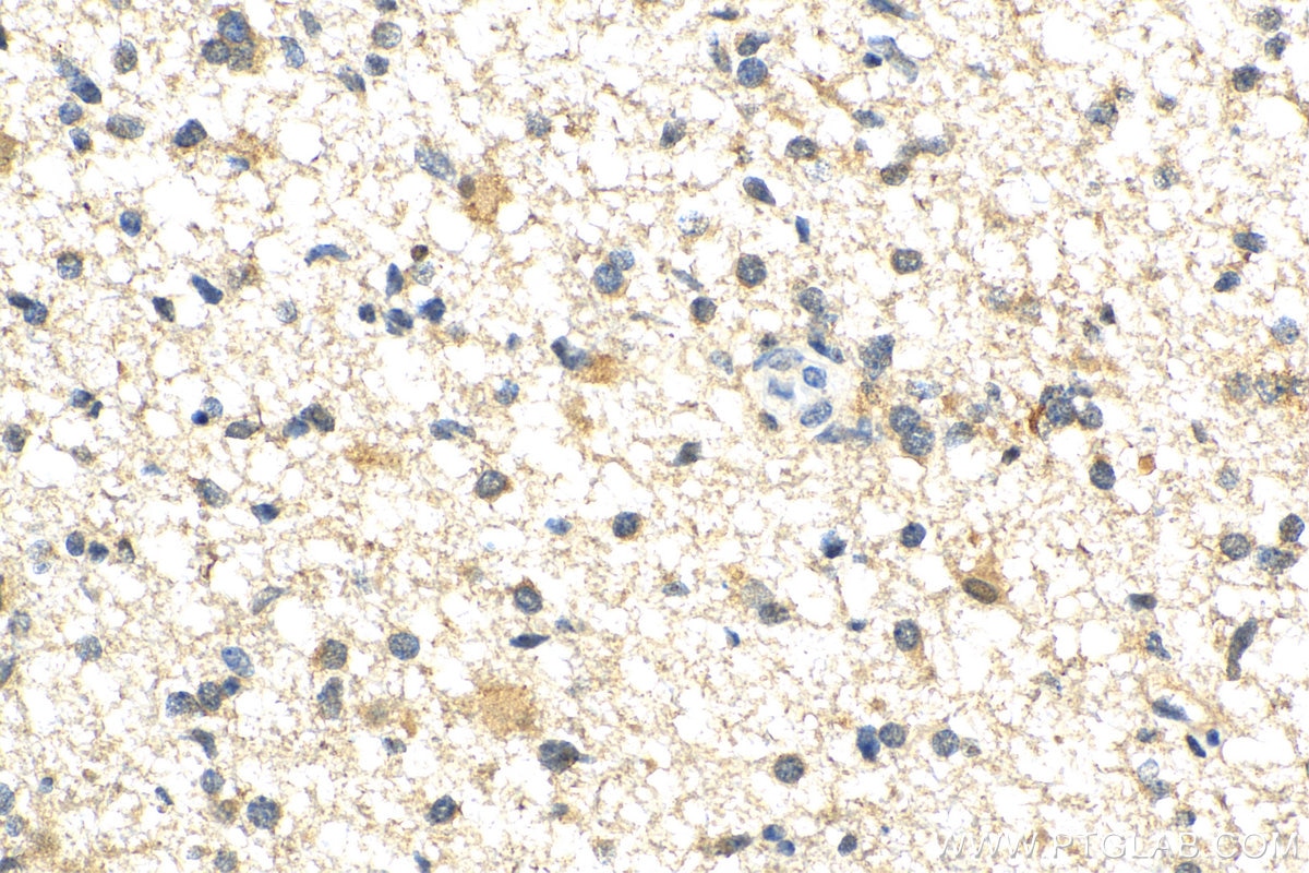 Immunohistochemistry (IHC) staining of human gliomas tissue using BCL11A Polyclonal antibody (11613-1-AP)