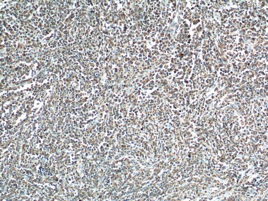 Immunohistochemistry (IHC) staining of human lymphoma tissue using human BCL2 Polyclonal antibody (12789-1-AP)