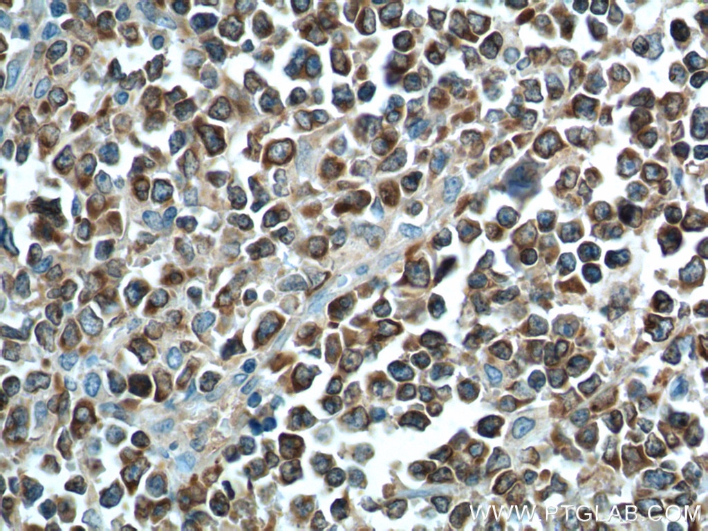 Immunohistochemistry (IHC) staining of human lymphoma tissue using human BCL2 Polyclonal antibody (12789-1-AP)