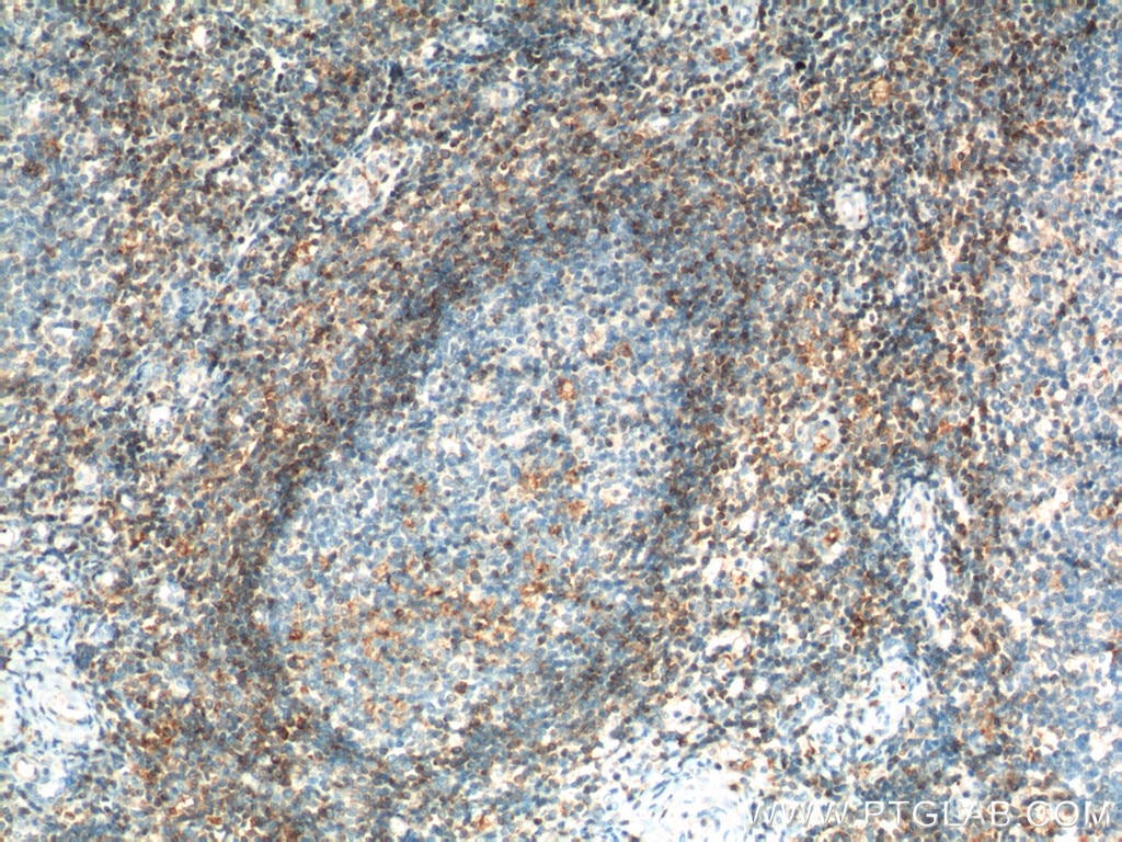 Immunohistochemistry (IHC) staining of human tonsillitis tissue using human BCL2 Polyclonal antibody (12789-1-AP)