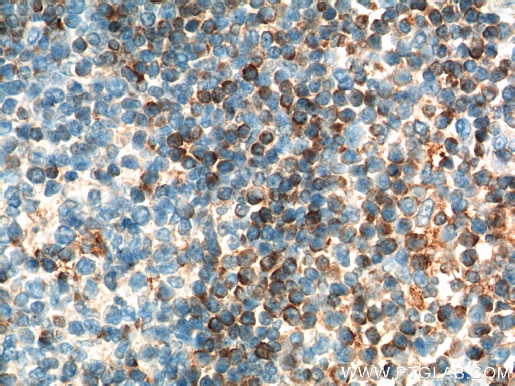 Immunohistochemistry (IHC) staining of human tonsillitis tissue using human BCL2 Polyclonal antibody (12789-1-AP)