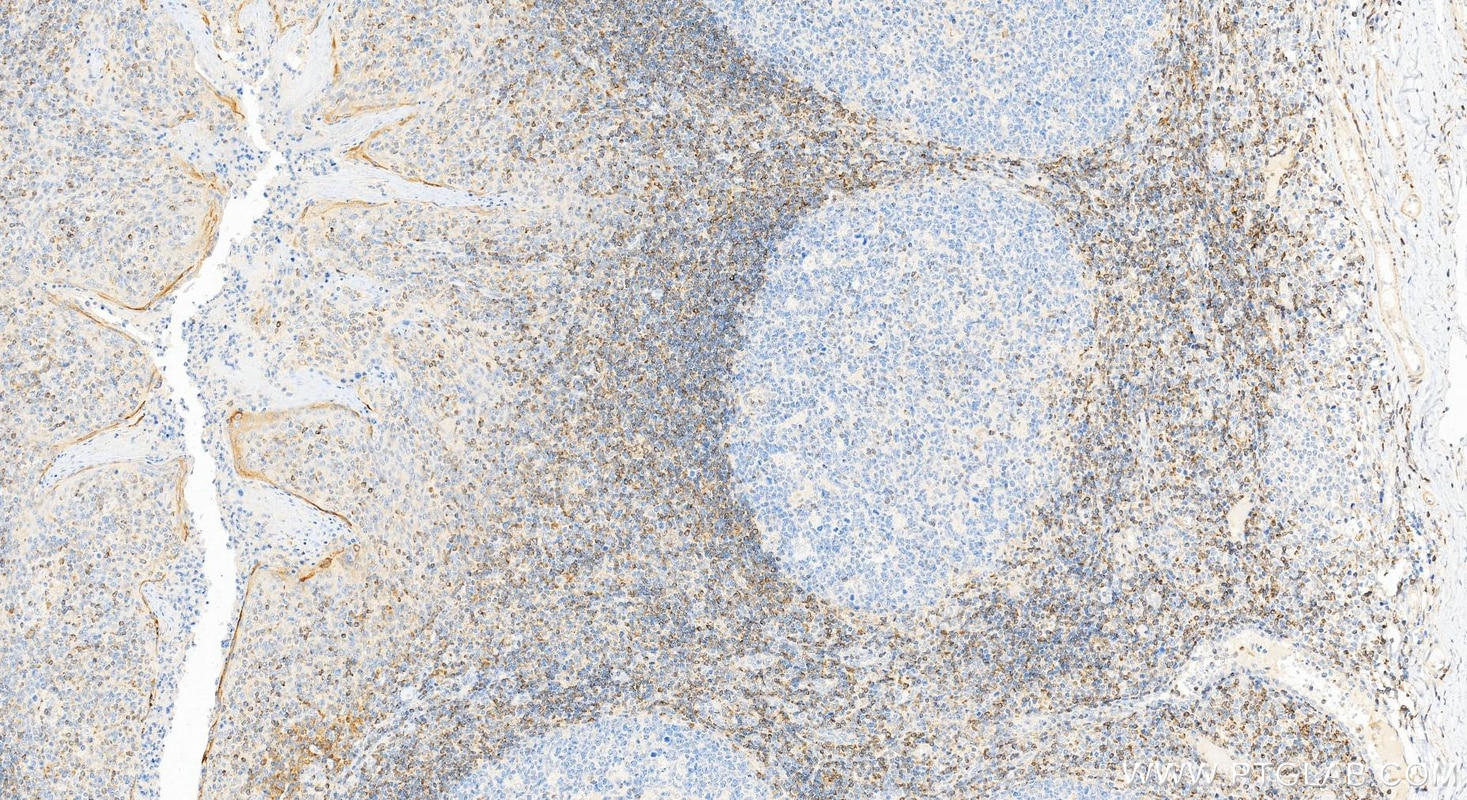 Immunohistochemical analysis of paraffin-embedded human tonsillitis tissue slide using 12789-1-AP (human BCL2 antibody) at dilution of 1:4000 (under 20x lens). Heat mediated antigen retrieval with Tris-EDTA buffer (pH 9.0). Immunohistochemistry (IHC) staining of human tonsillitis tissue using human BCL2 Polyclonal antibody (12789-1-AP)