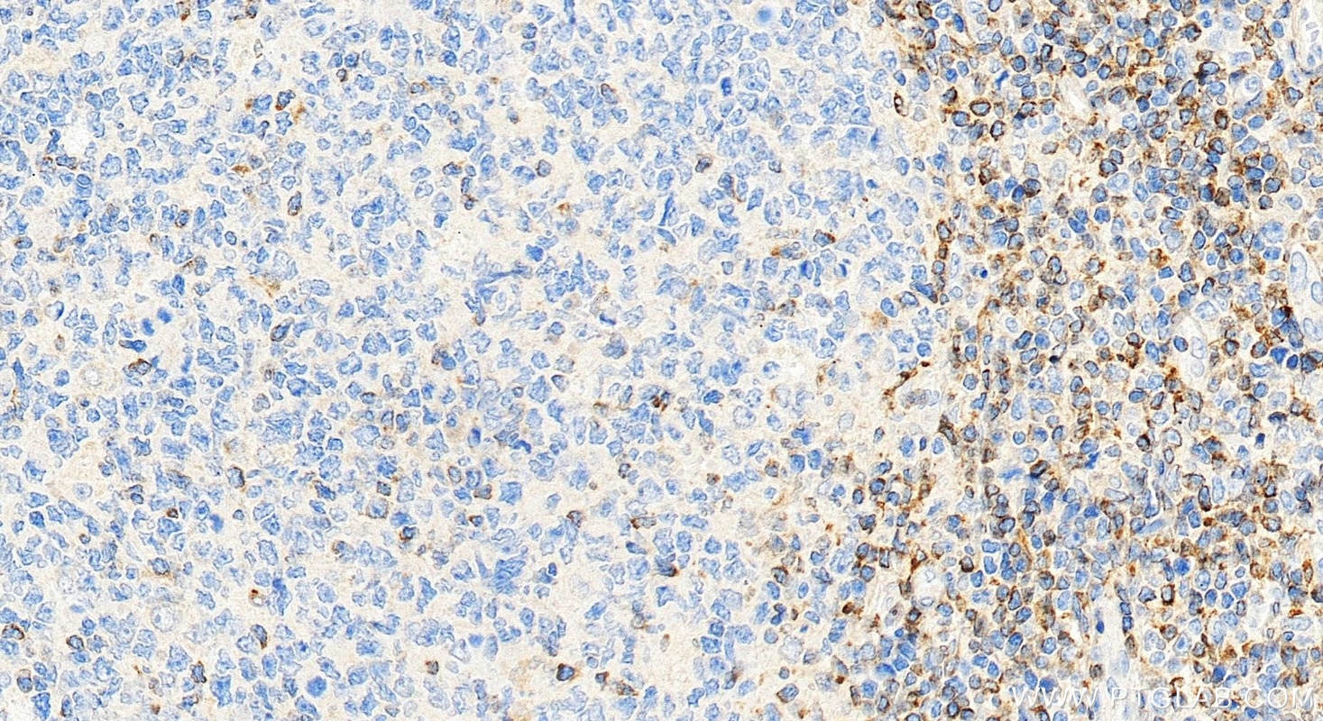 Immunohistochemical analysis of paraffin-embedded human tonsillitis tissue slide using 12789-1-AP (human BCL2 antibody) at dilution of 1:4000 (under 20x lens). Heat mediated antigen retrieval with Tris-EDTA buffer (pH 9.0). Immunohistochemistry (IHC) staining of human tonsillitis tissue using human BCL2 Polyclonal antibody (12789-1-AP)