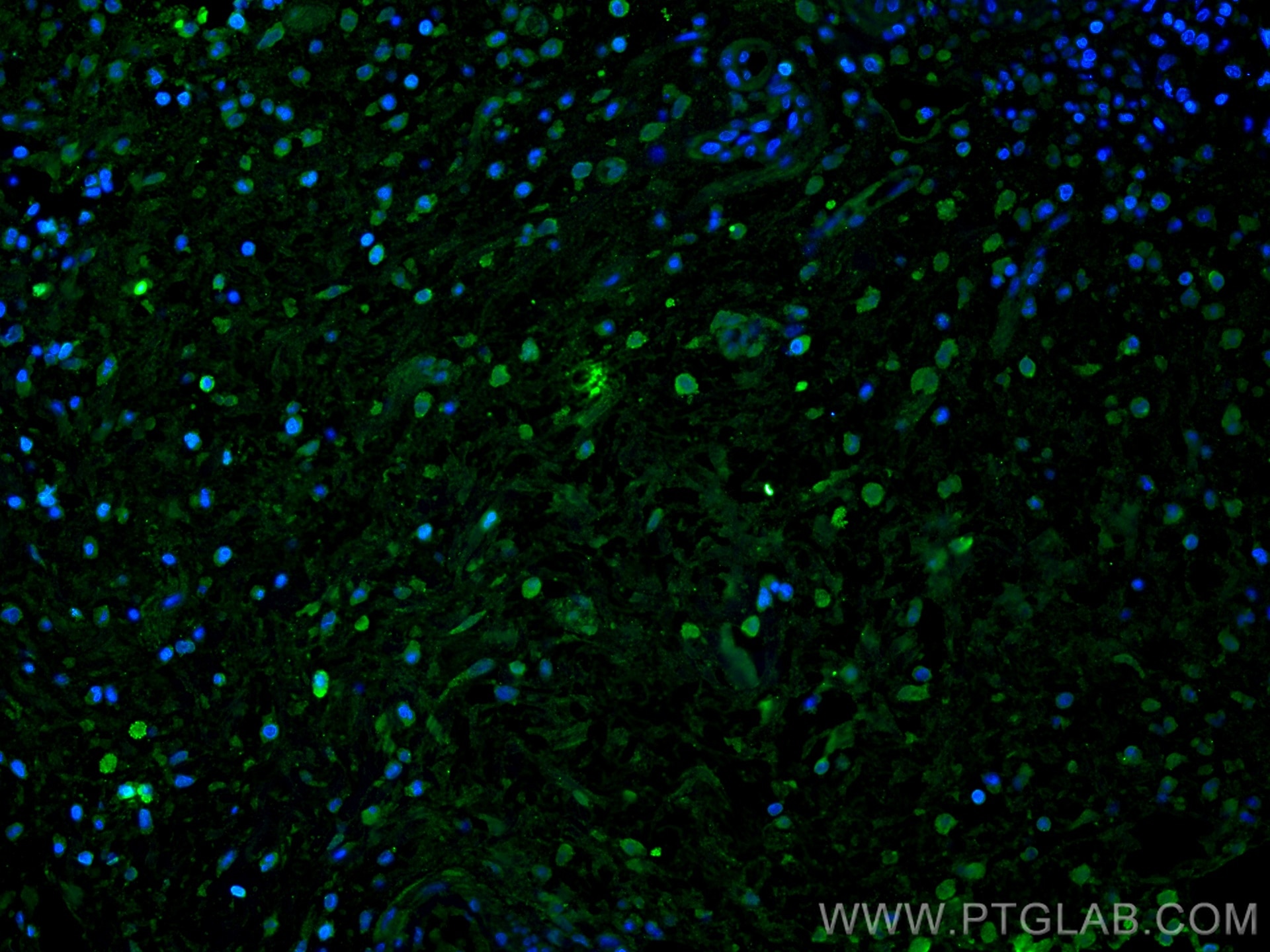 Immunofluorescence (IF) / fluorescent staining of human appendicitis tissue using BCL2 Monoclonal antibody (60178-1-Ig)