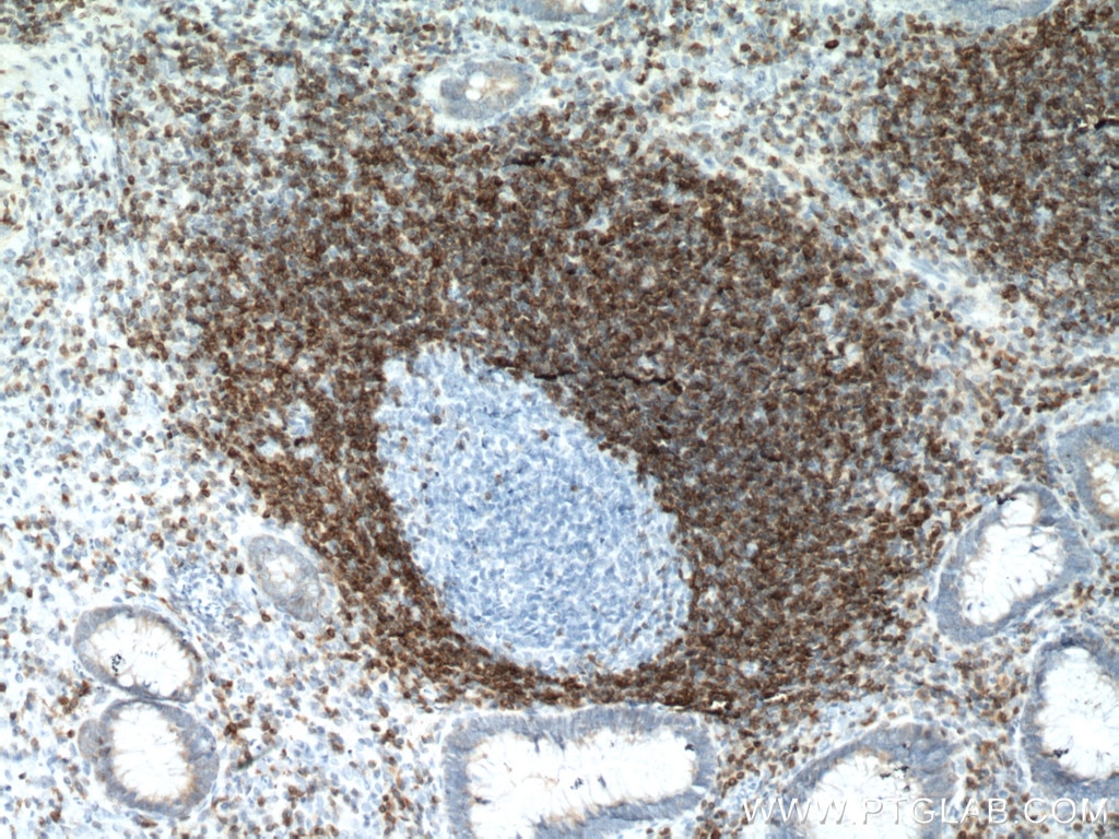 Immunohistochemistry (IHC) staining of human appendicitis tissue using BCL2 Monoclonal antibody (60178-1-Ig)