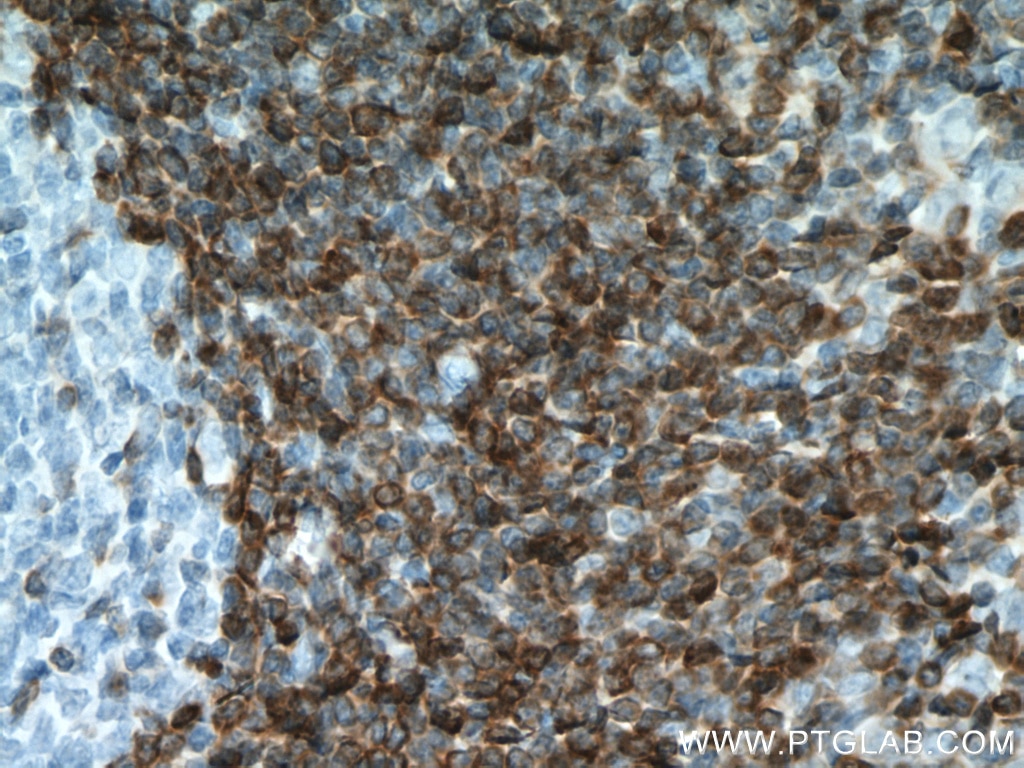 Immunohistochemistry (IHC) staining of human appendicitis tissue using BCL2 Monoclonal antibody (60178-1-Ig)