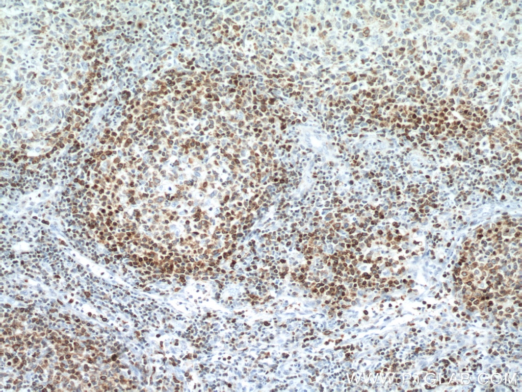 Immunohistochemistry (IHC) staining of human lymphoma tissue using BCL2 Monoclonal antibody (60178-1-Ig)