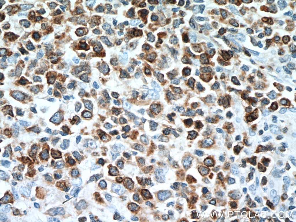 Immunohistochemistry (IHC) staining of human lymphoma tissue using BCL2 Monoclonal antibody (60178-1-Ig)