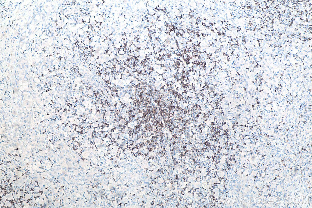Immunohistochemistry (IHC) staining of human lymphoma tissue using BCL2 Monoclonal antibody (60178-1-Ig)