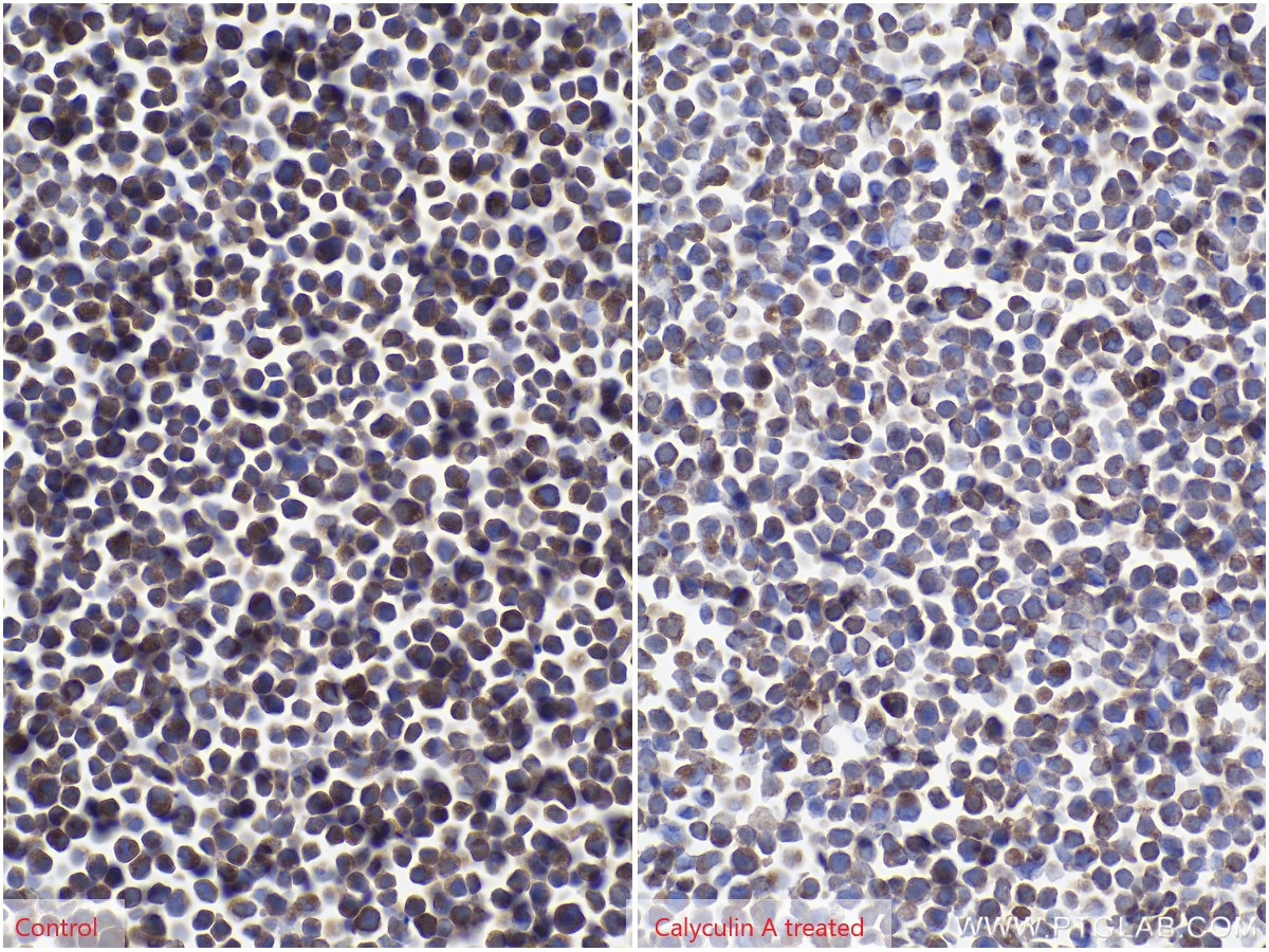 Immunohistochemistry (IHC) staining of Jurkat cells using BCL2 Monoclonal antibody (60178-1-Ig)