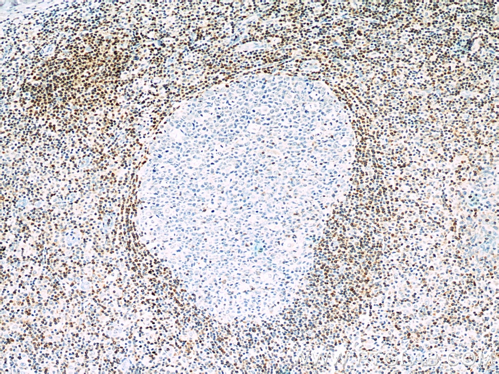 Immunohistochemistry (IHC) staining of human tonsillitis tissue using BCL2 Monoclonal antibody (60178-1-Ig)