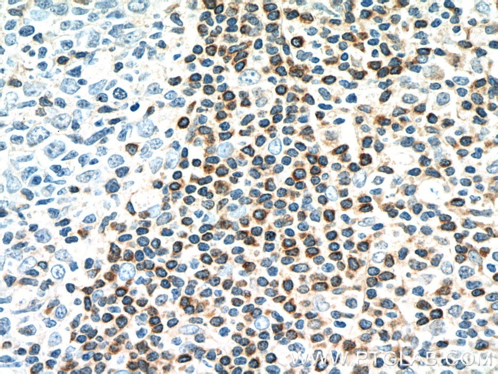 Immunohistochemistry (IHC) staining of human tonsillitis tissue using BCL2 Monoclonal antibody (60178-1-Ig)