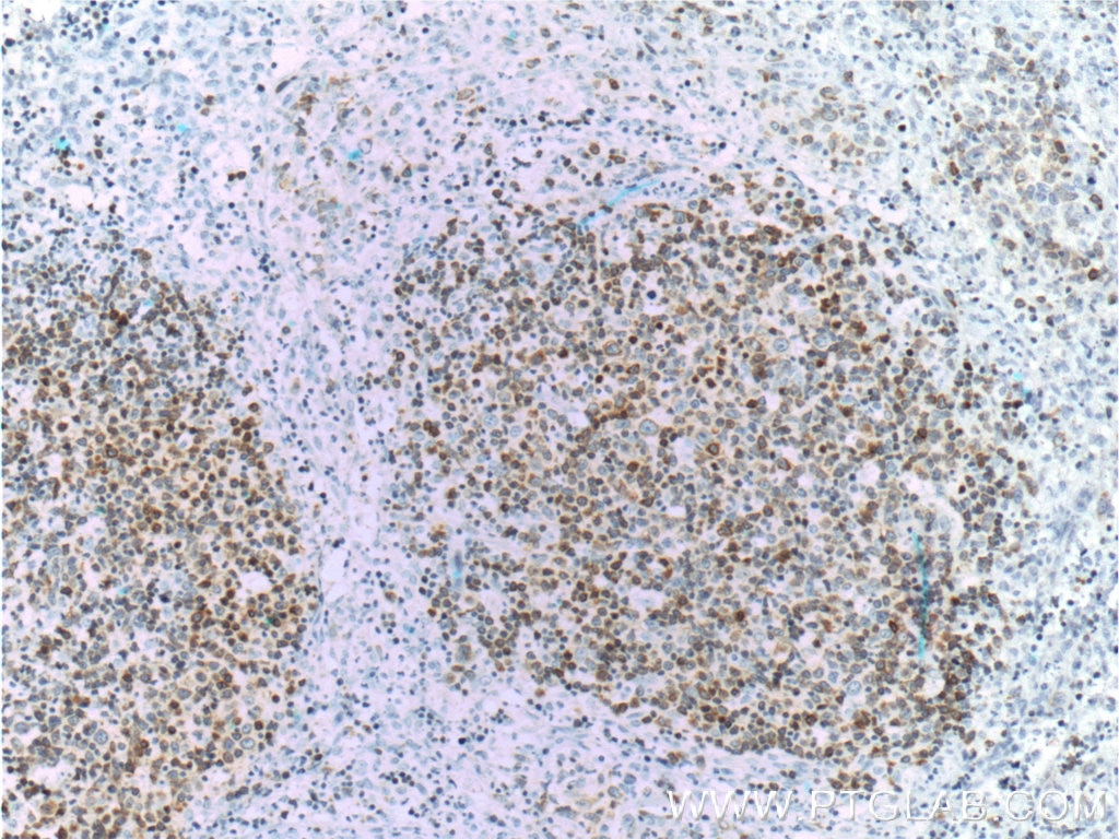 IHC staining of human lymphoma using 60178-1-Ig