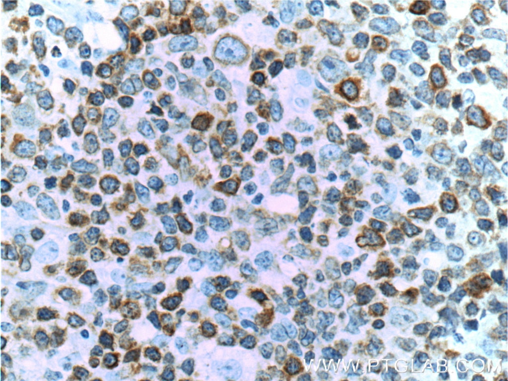 IHC staining of human lymphoma using 60178-1-Ig