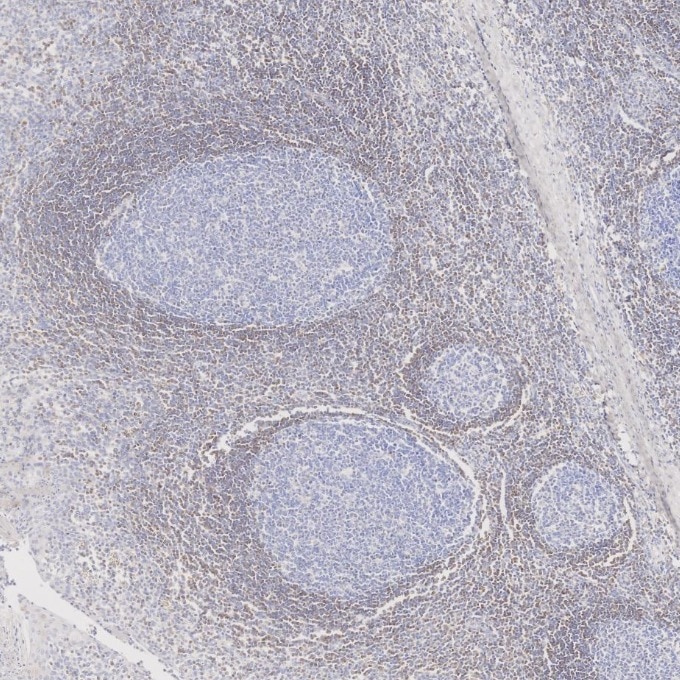 IHC staining of human tonsillitis using 60178-1-Ig Immunohistochemistry (IHC) staining of human tonsillitis tissue using BCL2 Monoclonal antibody (60178-1-Ig)