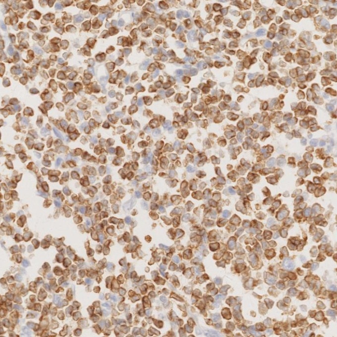 IHC staining of human lymphoma using 60178-1-Ig Immunohistochemistry (IHC) staining of human lymphoma tissue using BCL2 Monoclonal antibody (60178-1-Ig)