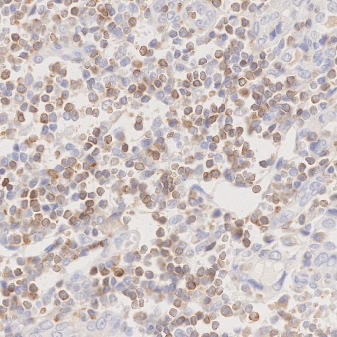 IHC staining of human lymphoma using 60178-1-Ig Immunohistochemistry (IHC) staining of human lymphoma tissue using BCL2 Monoclonal antibody (60178-1-Ig)