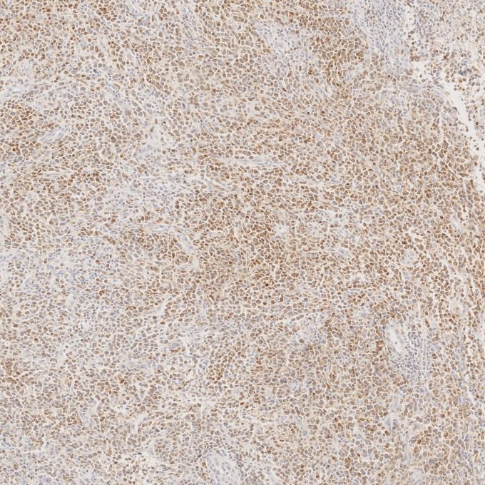 IHC staining of human lymphoma using 60178-1-Ig Immunohistochemistry (IHC) staining of human lymphoma tissue using BCL2 Monoclonal antibody (60178-1-Ig)