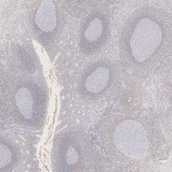 IHC staining of human appendicitis using 60178-1-Ig Immunohistochemistry (IHC) staining of human appendicitis tissue using BCL2 Monoclonal antibody (60178-1-Ig)