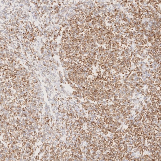 IHC staining of human lymphoma using 60178-1-Ig Immunohistochemistry (IHC) staining of human lymphoma tissue using BCL2 Monoclonal antibody (60178-1-Ig)
