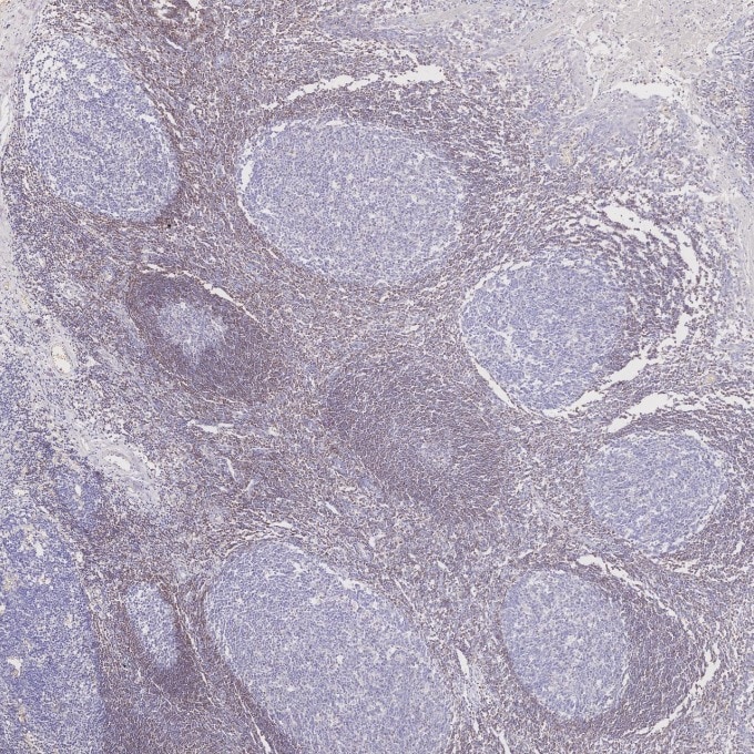 IHC staining of human tonsillitis using 60178-1-Ig Immunohistochemistry (IHC) staining of human tonsillitis tissue using BCL2 Monoclonal antibody (60178-1-Ig)
