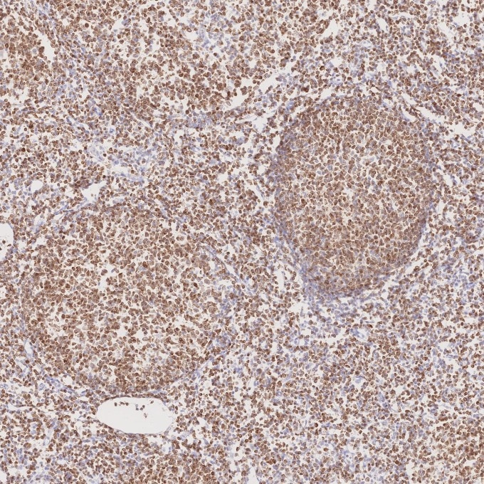 IHC staining of human lymphoma using 60178-1-Ig Immunohistochemistry (IHC) staining of human lymphoma tissue using BCL2 Monoclonal antibody (60178-1-Ig)