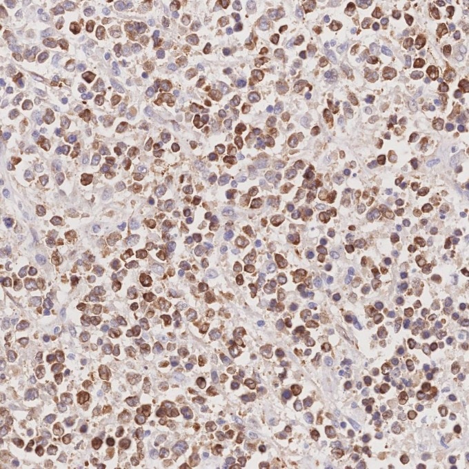 IHC staining of human lymphoma using 60178-1-Ig Immunohistochemistry (IHC) staining of human lymphoma tissue using BCL2 Monoclonal antibody (60178-1-Ig)