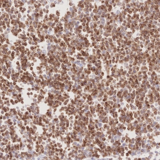 IHC staining of human lymphoma using 60178-1-Ig Immunohistochemistry (IHC) staining of human lymphoma tissue using BCL2 Monoclonal antibody (60178-1-Ig)