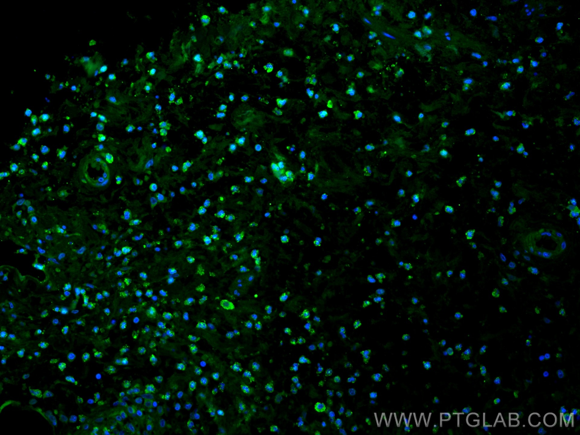 Immunofluorescence (IF) / fluorescent staining of human appendicitis tissue using BCL2 Recombinant antibody (80313-1-RR)