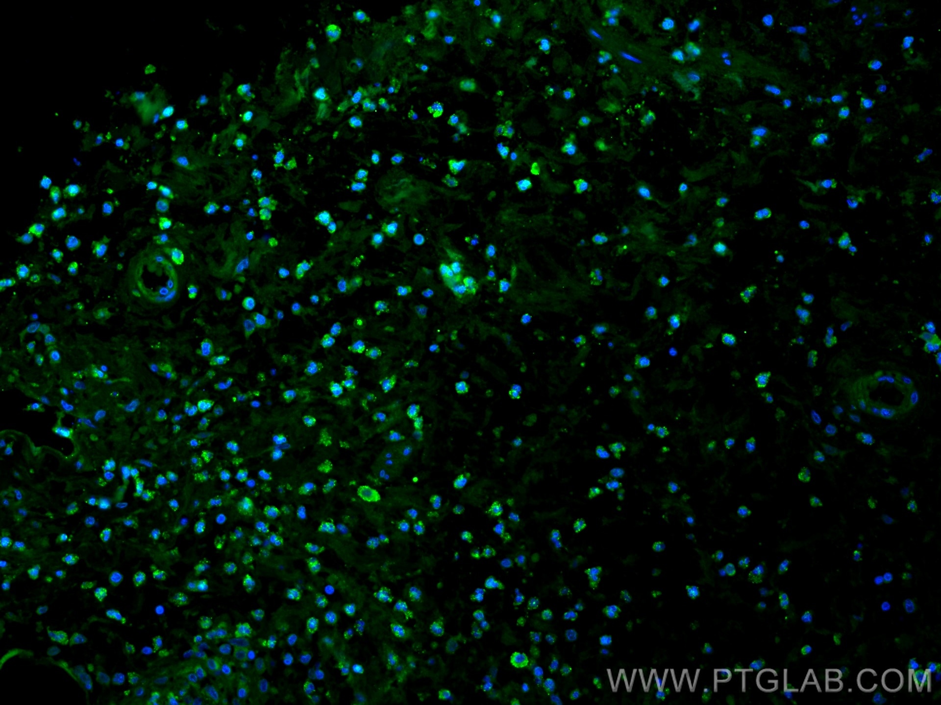 IF Staining of human appendicitis using 80313-1-RR